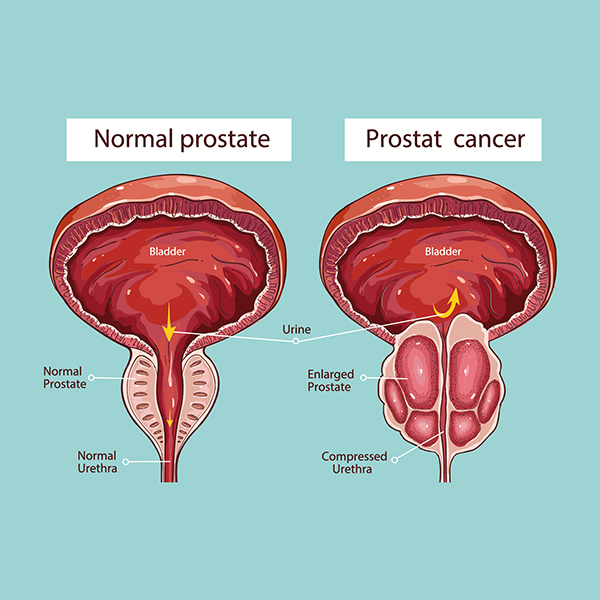 cancer de prostata ultima faza